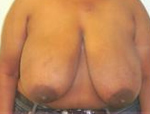 Patient # 76288 Before Photo # 1