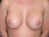 Patient # 87035 After Photo # 2