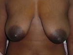 Patient # 71265 Before Photo # 1