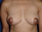 Patient # 92871 After Photo # 2
