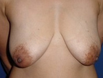 Patient # 92871 Before Photo # 1