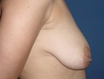 Patient # 92871 Before Photo # 3