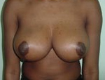 Patient # 98981 After Photo # 2