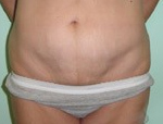 Patient # 54184 After Photo # 2