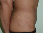 Patient # 16304 After Photo # 2