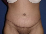 Patient # 18420 After Photo # 2