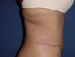 Patient # 18420 After Photo # 4