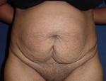 Patient # 18420 Before Photo # 1