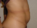 Patient # 87180 Before Photo # 3