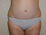 Patient # 49993 After Photo # 2