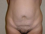 Patient # 49993 Before Photo # 1