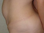 Patient # 49993 Before Photo # 3