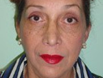 Patient # 17774 After Photo # 2