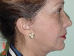 Patient # 17774 After Photo # 4