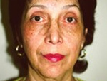 Patient # 17774 Before Photo # 1