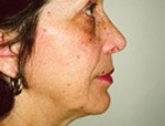 Patient # 17774 Before Photo # 3