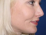 Patient # 42939 After Photo # 4