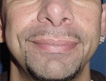 Patient # 97234 After Photo # 2