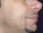 Patient # 97234 After Photo # 4