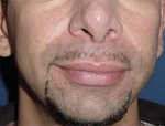 Patient # 97234 Before Photo # 1