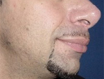 Patient # 97234 Before Photo # 3