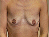 Patient # 69843 Before Photo # 1