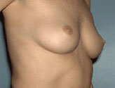 Patient # 20618 Before Photo # 1