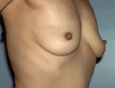Patient # 43731 Before Photo # 1