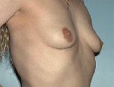 Patient # 66093 Before Photo # 1