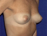 Patient # 76029 Before Photo # 1