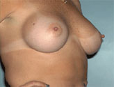 Patient # 84396 After Photo # 2