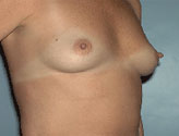 Patient # 84396 Before Photo # 1