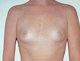 Patient # 81571 Before Photo # 1