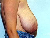 Patient # 41094 Before Photo # 1