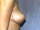 Patient # 64685 After Photo # 2
