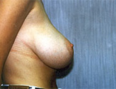 Patient # 64685 Before Photo # 1