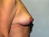 Patient # 79290 After Photo # 2