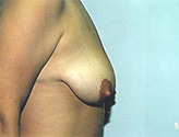 Patient # 79290 Before Photo # 1