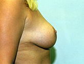 Patient # 93590 After Photo # 2