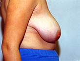 Patient # 93590 Before Photo # 1