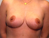Patient # 15652 After Photo # 2