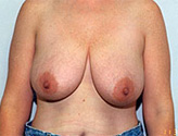 Patient # 15652 Before Photo # 1