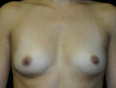 Patient # 57836 Before Photo # 1