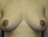 Patient # 46450 After Photo # 2