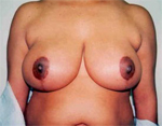 Patient # 23112 After Photo # 2