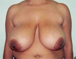 Patient # 23112 Before Photo # 1