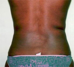 Patient # 55712 After Photo # 2