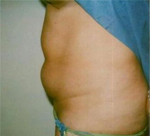 Patient # 69577 Before Photo # 1