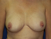 Patient # 57458 After Photo # 2