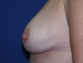 Patient # 57458 After Photo # 4